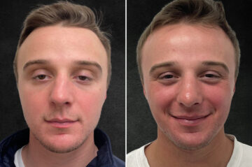 Rhinoplasty Before and After Photos in Freehold, NJ, Patient 5163
