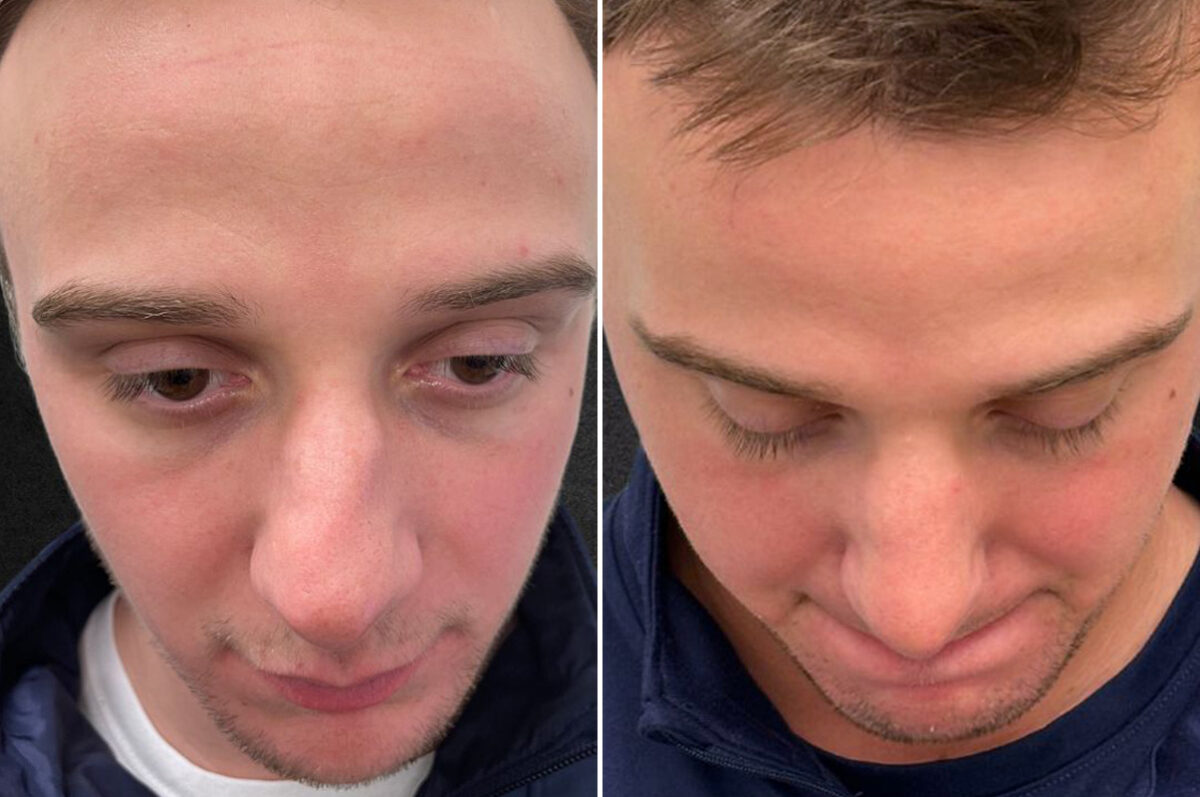 Patient 5163, Rhinoplasty Before and After Photos Rhinoplasty Before and After Photos in Freehold, NJ, Patient 5163