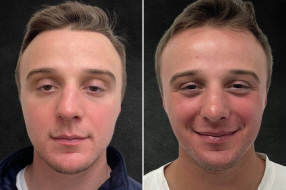 Rhinoplasty Before and After Photos in Freehold, NJ, Patient 5163