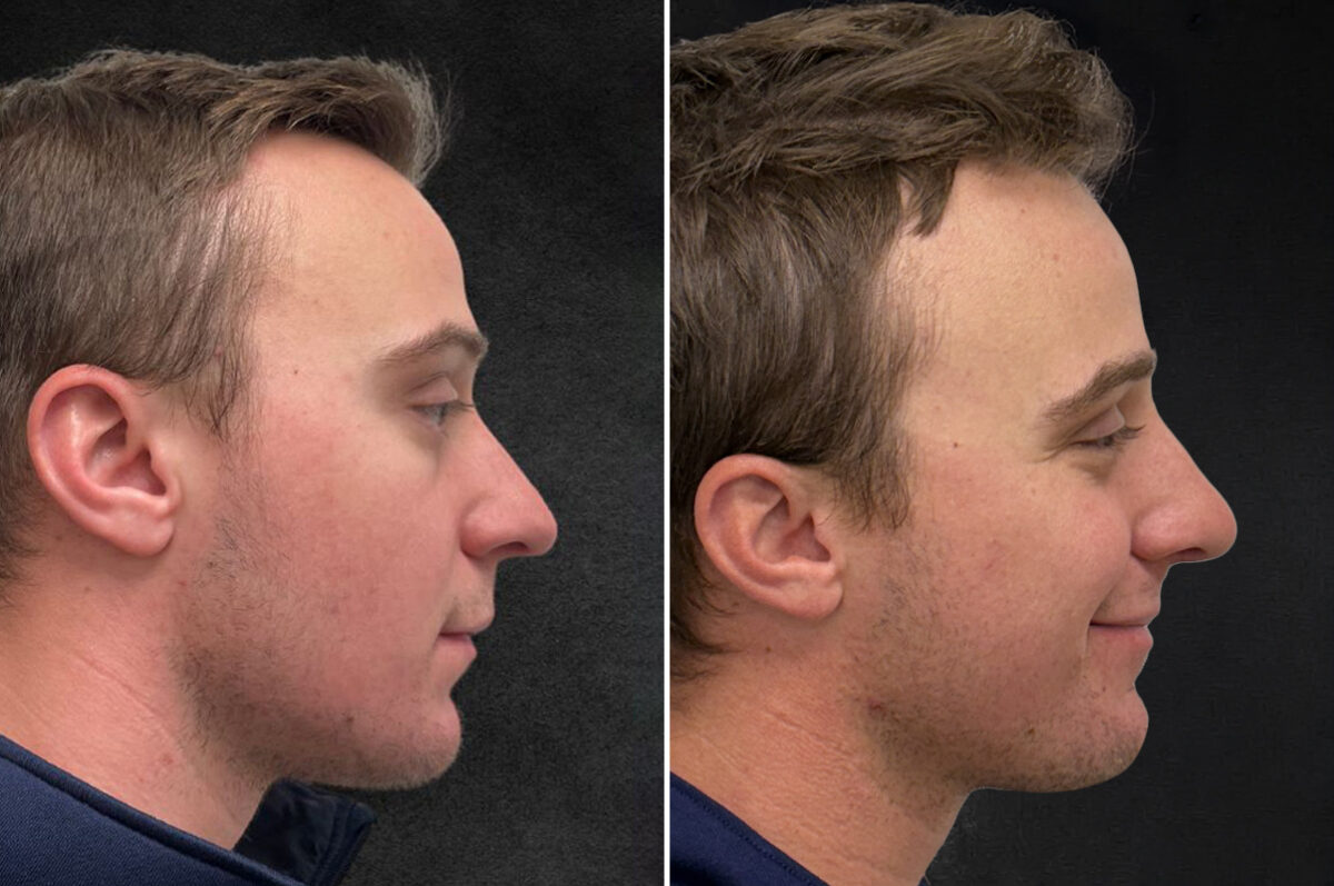 Rhinoplasty Before and After Photos in Freehold, NJ, Patient 5163