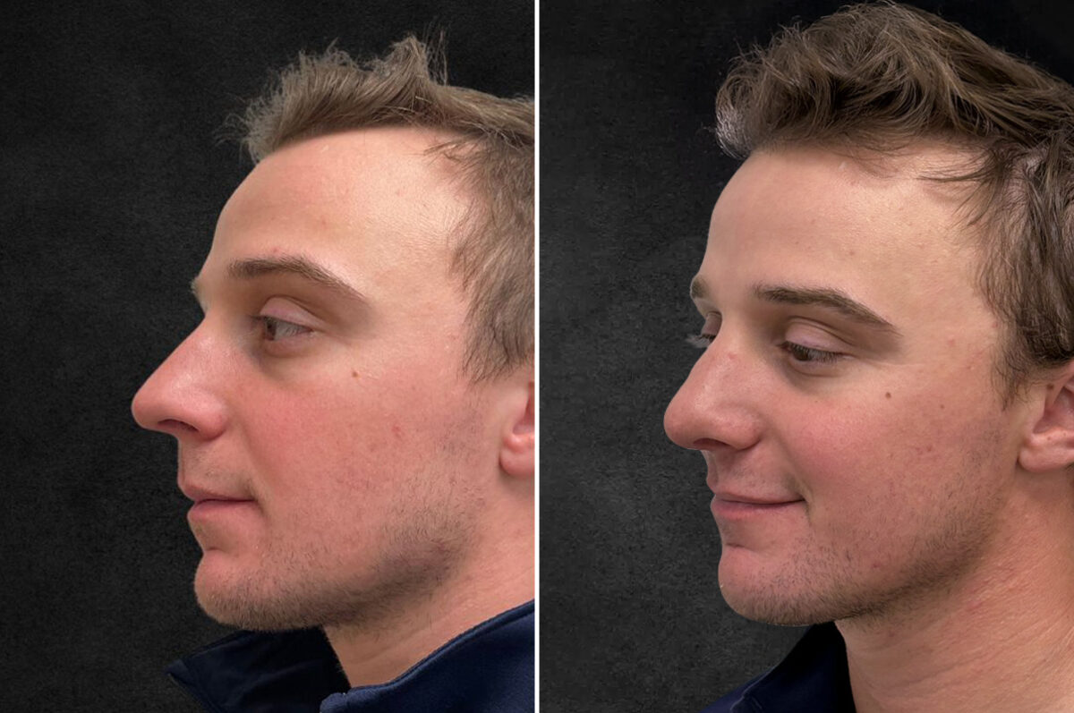 Rhinoplasty Before and After Photos in Freehold, NJ, Patient 5163