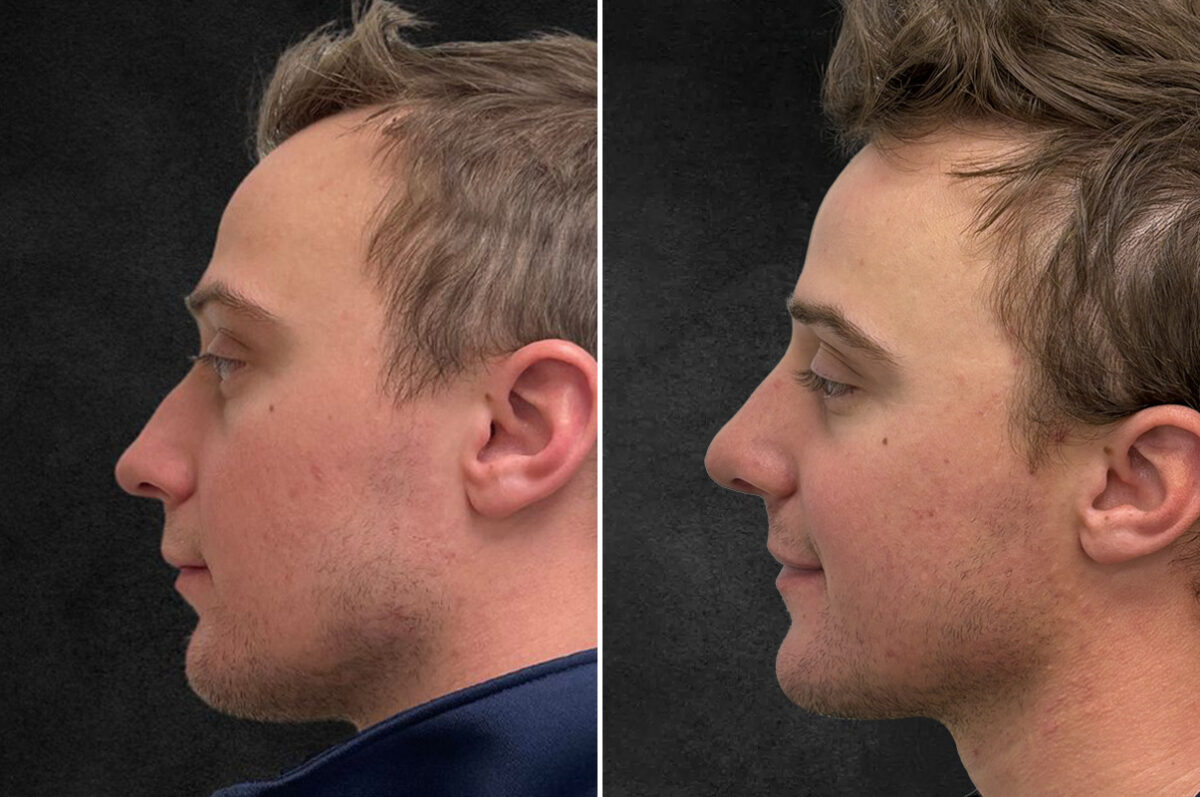 Rhinoplasty Before and After Photos in Freehold, NJ, Patient 5163