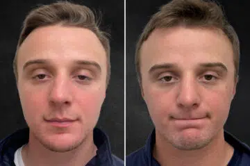 Rhinoplasty Before and After Photos in Freehold, NJ, Patient 5163