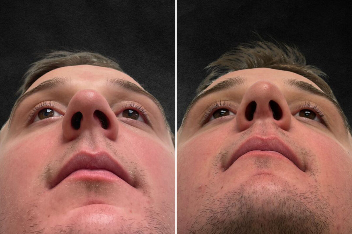 Rhinoplasty Before and After Photos in Freehold, NJ, Patient 5163
