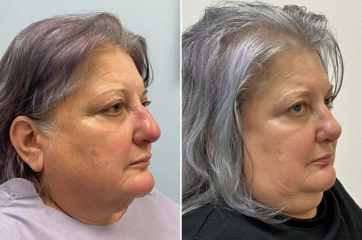 Rhinoplasty Before and After Photos in Freehold, NJ, Patient 6471