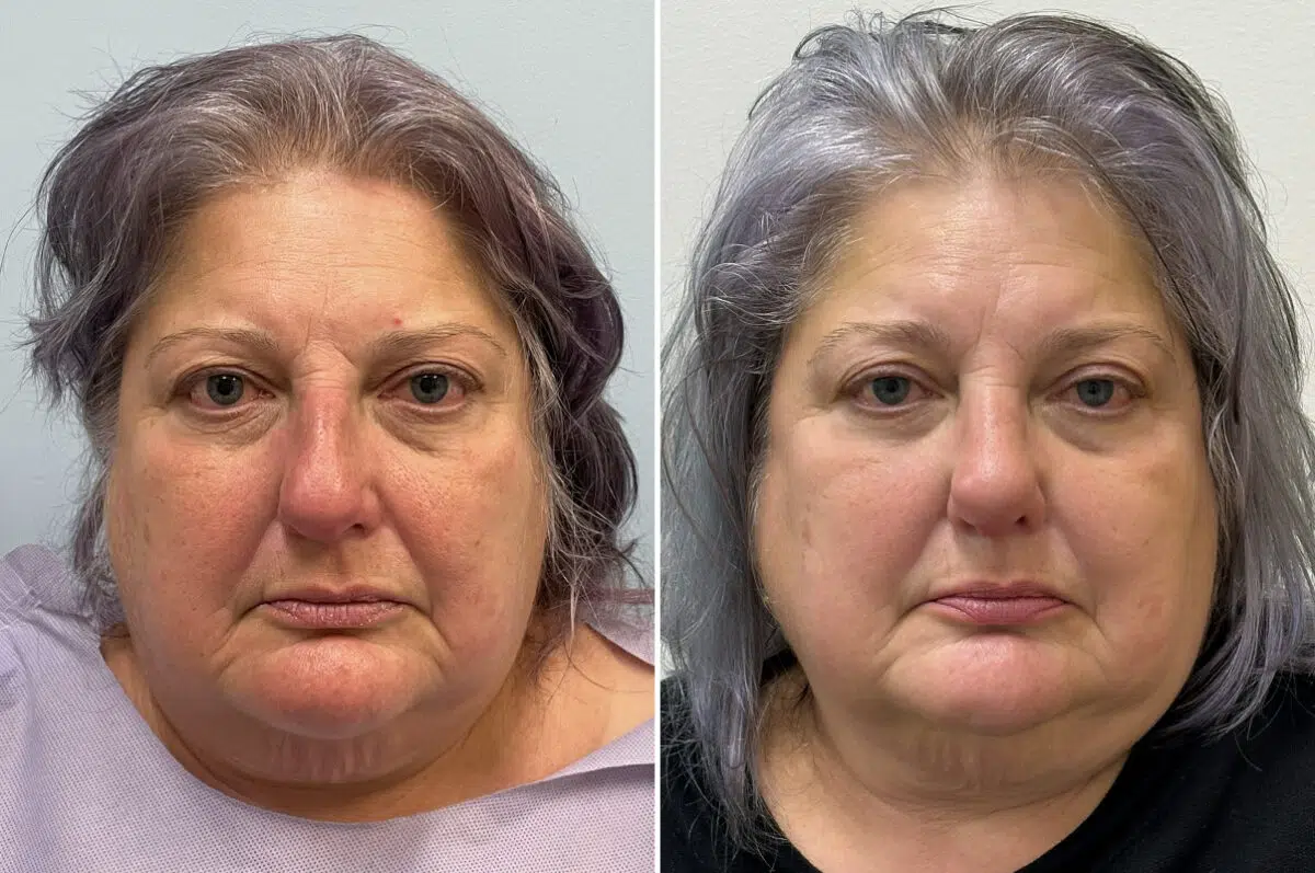 Rhinoplasty Before and After Photos in Freehold, NJ, Patient 6471