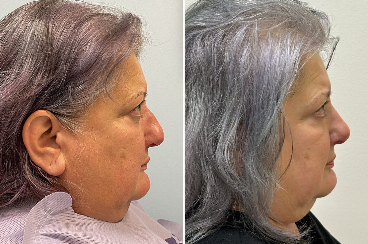 Rhinoplasty Before and After Photos in Freehold, NJ, Patient 6471