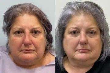 Rhinoplasty Before and After Photos in Freehold, NJ, Patient 6471