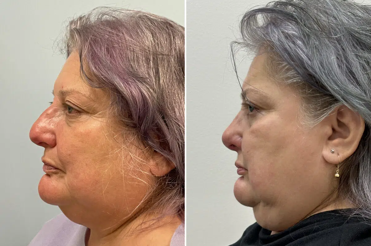 Rhinoplasty Before and After Photos in Freehold, NJ, Patient 6471