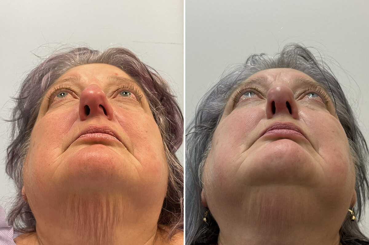 Rhinoplasty Before and After Photos in Freehold, NJ, Patient 6471